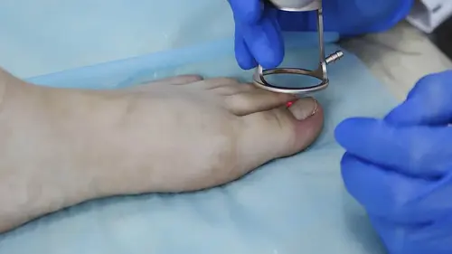 rimozione dell'unghia incarnita