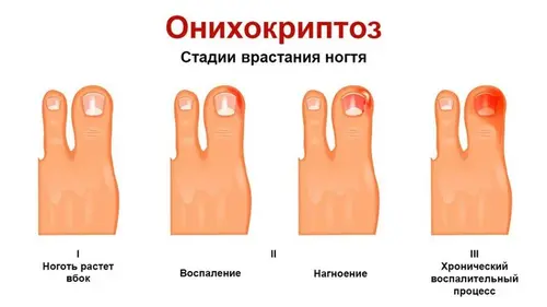 Onicocriptosi stadi di crescita dell'unghia